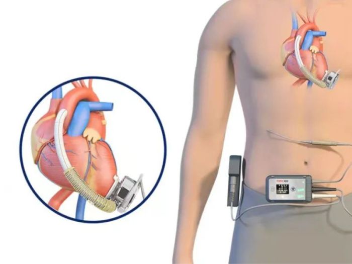 植入器械,超声波热合机