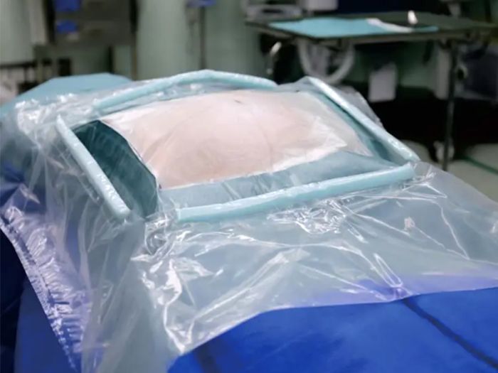 剖腹产一体化包,热合技术