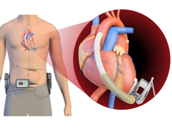 超声波热合机,医疗器械行业